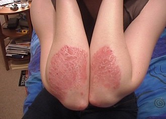 All About Psoriasis: What Does It Look Like, How To Control It, How Does It Affect Me? [And More]