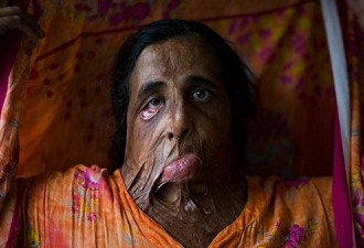 Continued Acid Attacks on Women Are Pulling Back South Asia: Need To Put An End