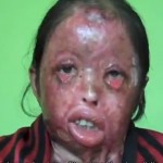 Ignored By The Administration, Acid Attack Victim Requests For Help