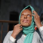 Burned With Acid For Spurning Sexual Advances